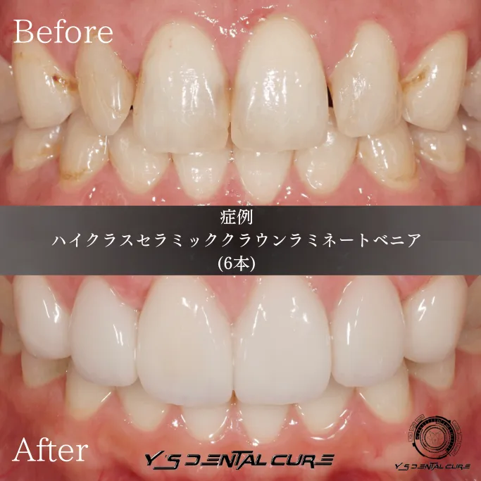 セラミックと歯列矯正、あなたに合った治療法とは?