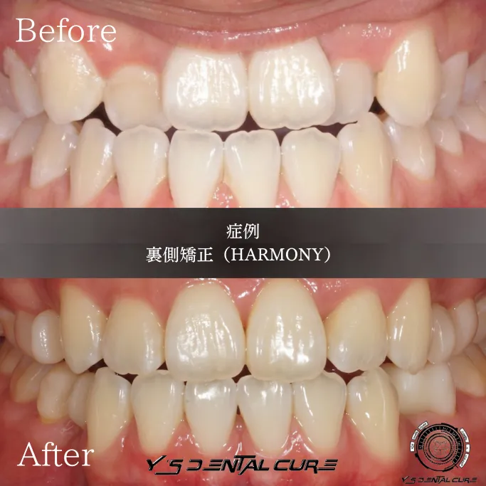 反対咬合の治療、裏側矯正で叶える自信ある笑顔