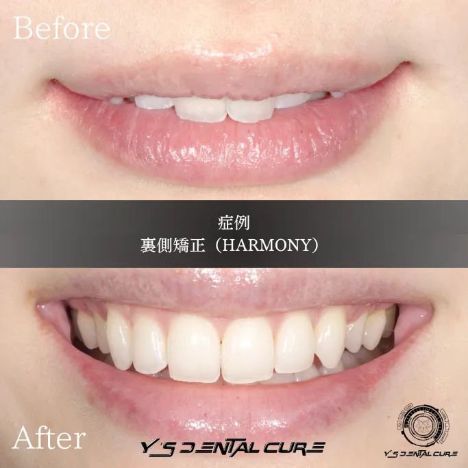 歯列矯正の誤解