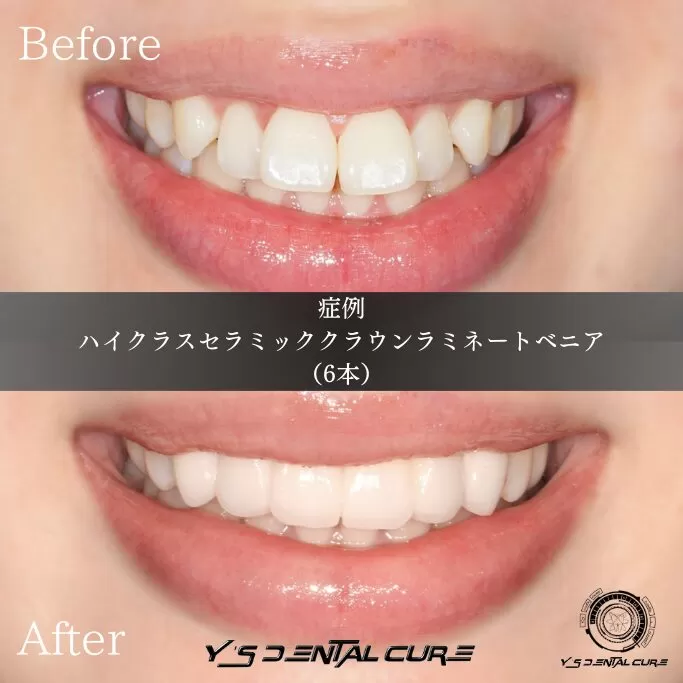 前歯だけ治す選択肢