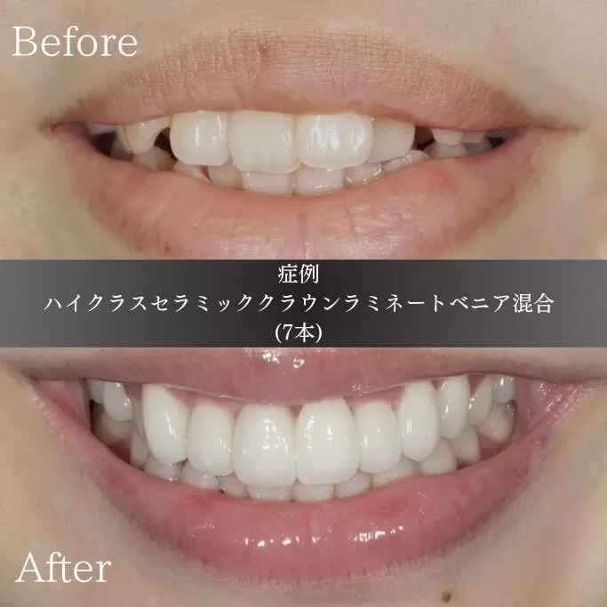 前歯を引っ込めたい