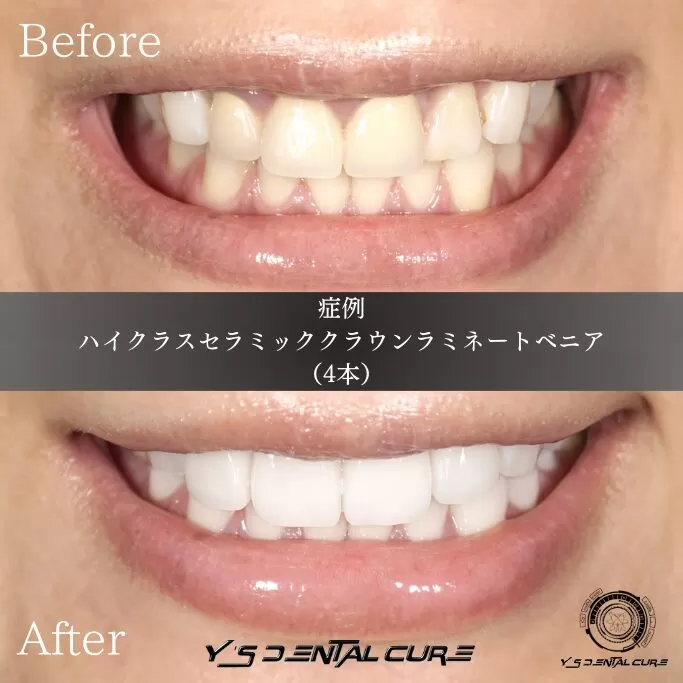 金属使用歯科治療においての咬合力による、持続的進行性カリエス(虫歯)