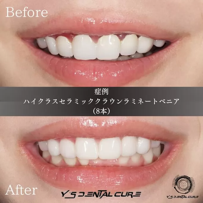 他院で入れたセラミックによる歯茎の炎症、再治療セラミック