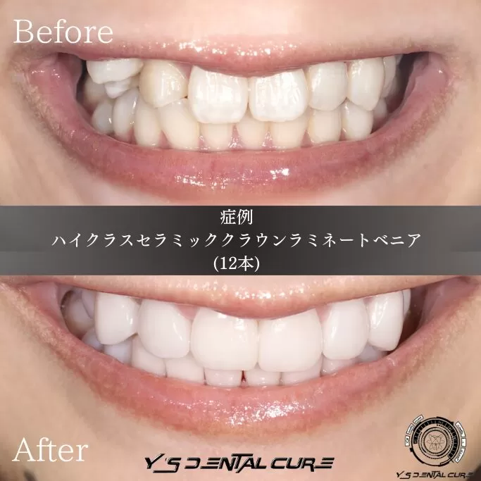 口角の位置 お顔の正中を正常化