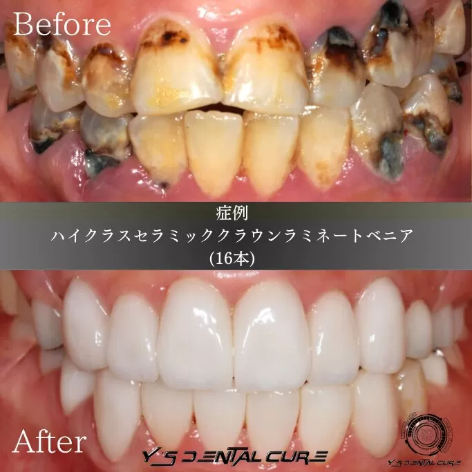 歯がボロボロ、失った歯の治療