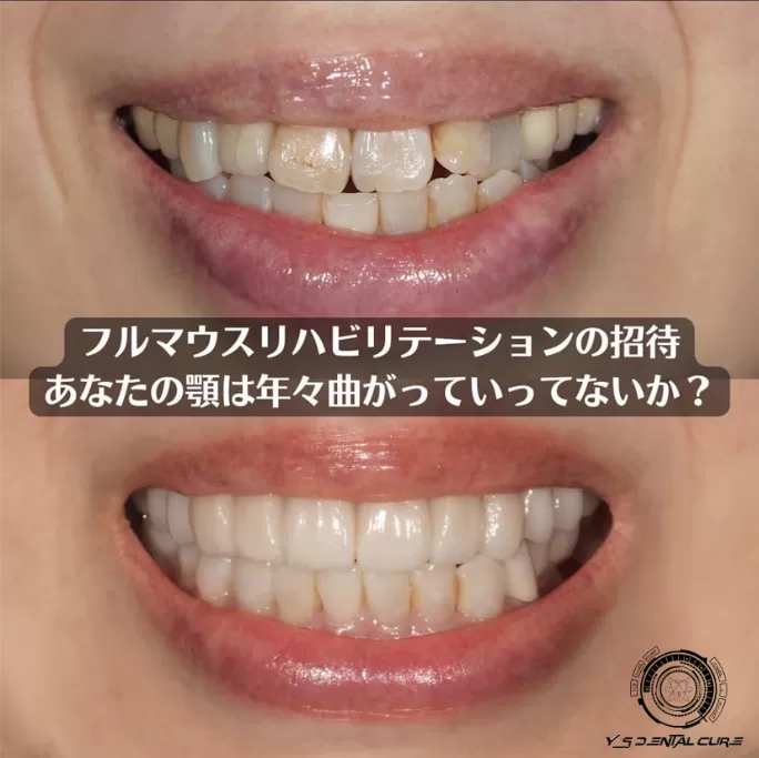 フルマウスリハビリテーションの招待