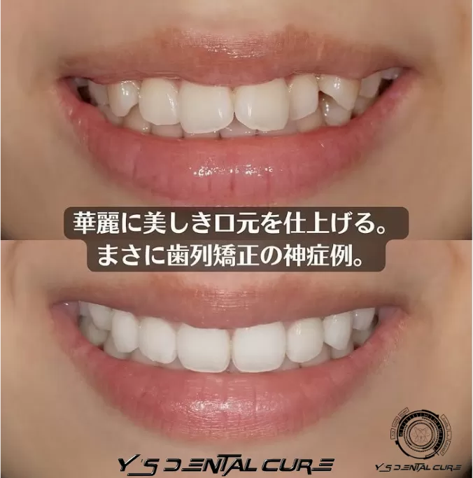 華麗に美しき口元を仕上げる裏側矯正