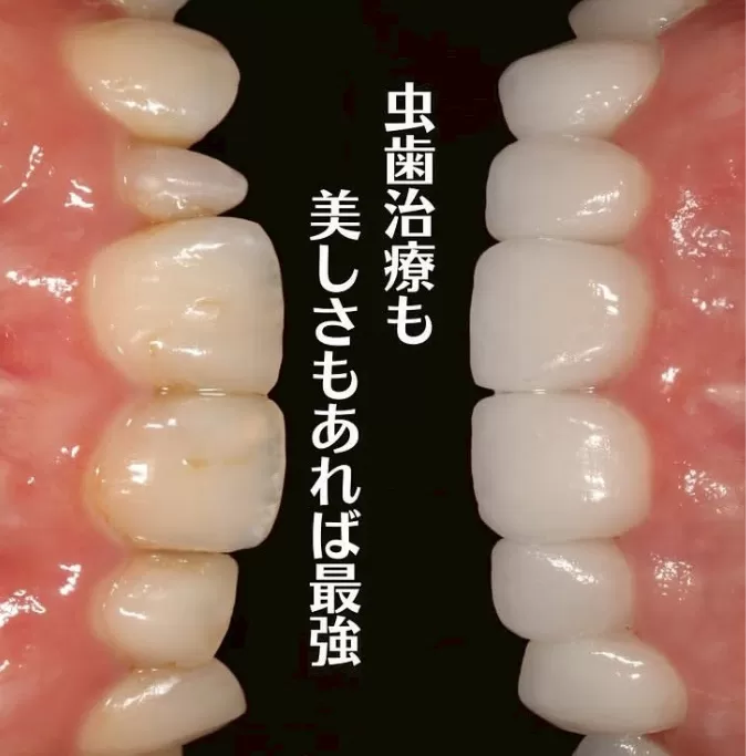 前歯の虫歯と矮小歯の改善