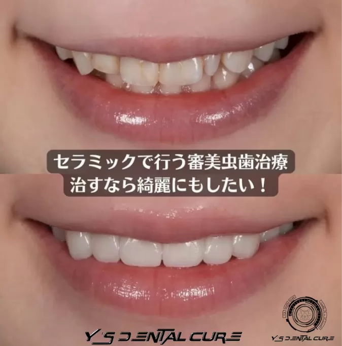 セラミックで行う審美虫歯治療