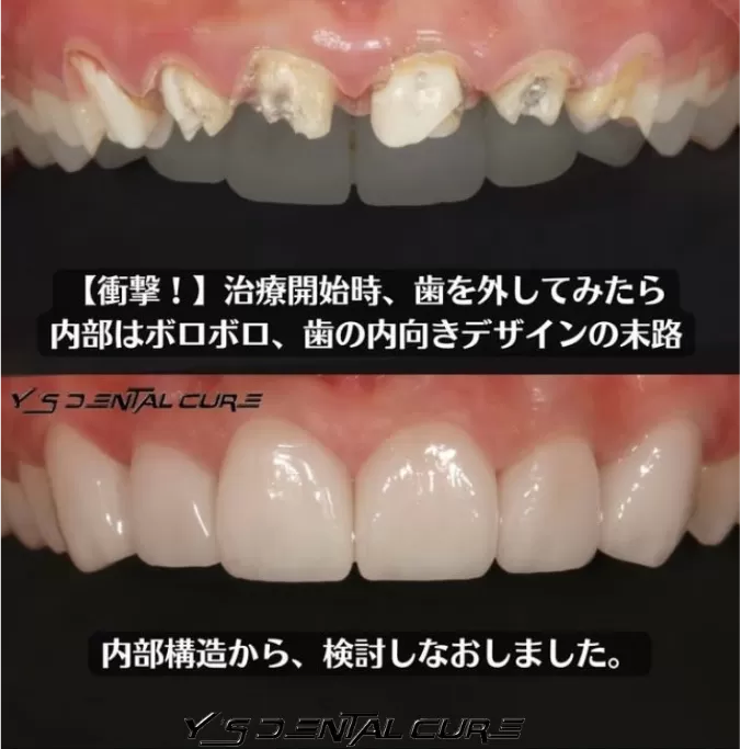 審美歯科治療のやり直し