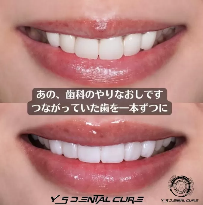 繋がっていた歯を1本ずつに、再治療セラミック